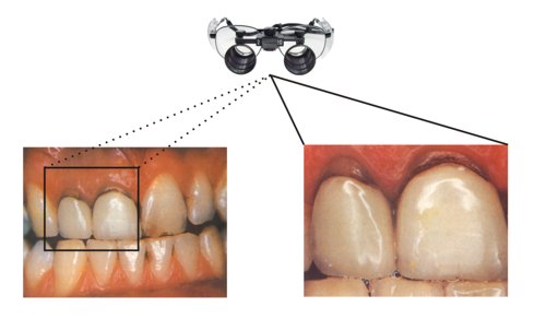 2.5x powikszenie obrazu przez lupy dentystyczne